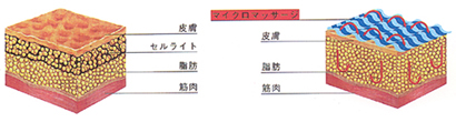 セルライト対策ダイエットに「ターボセル」